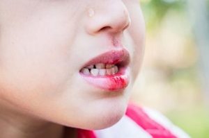انواع آسیب دیدگی دندان کودکان