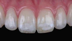 تغییر رنگ دندان در اثر مصرف فلوراید