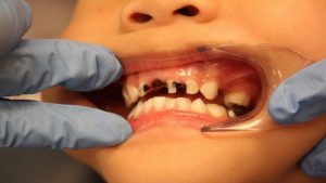 مشکلات دندانپزشکی کودکان