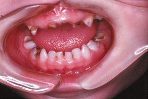 بیماری های دهان و دندان در کودکان