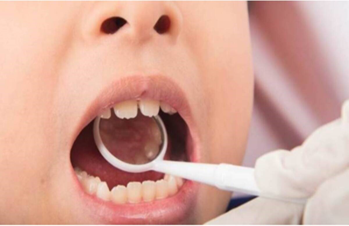 جلوگیری از کج شدن دندان کودکان