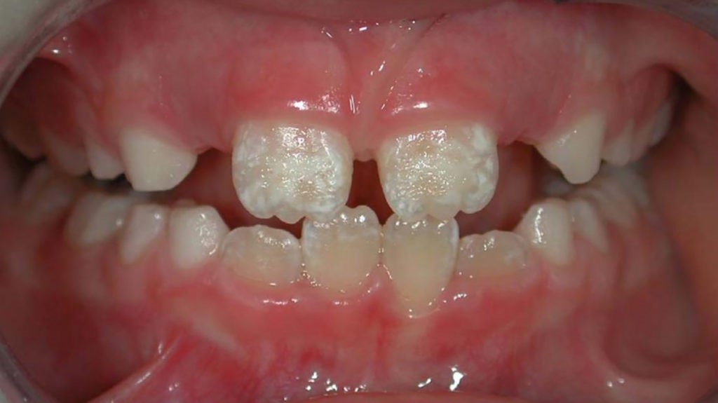 دندان گچی در کودکان