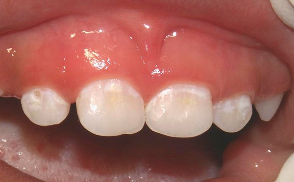 دندان گچی در کودکان