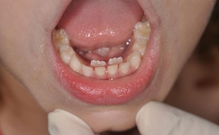 دندان اضافی یا دندان نهفته در کودکان