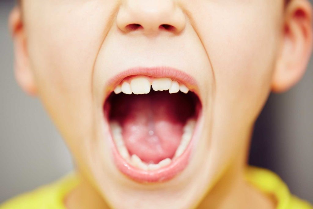 نامرتب بودن دندان کودکان