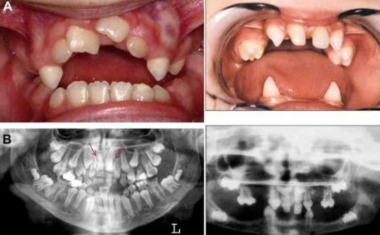 دندان اضافی یا دندان نهفته در کودکان