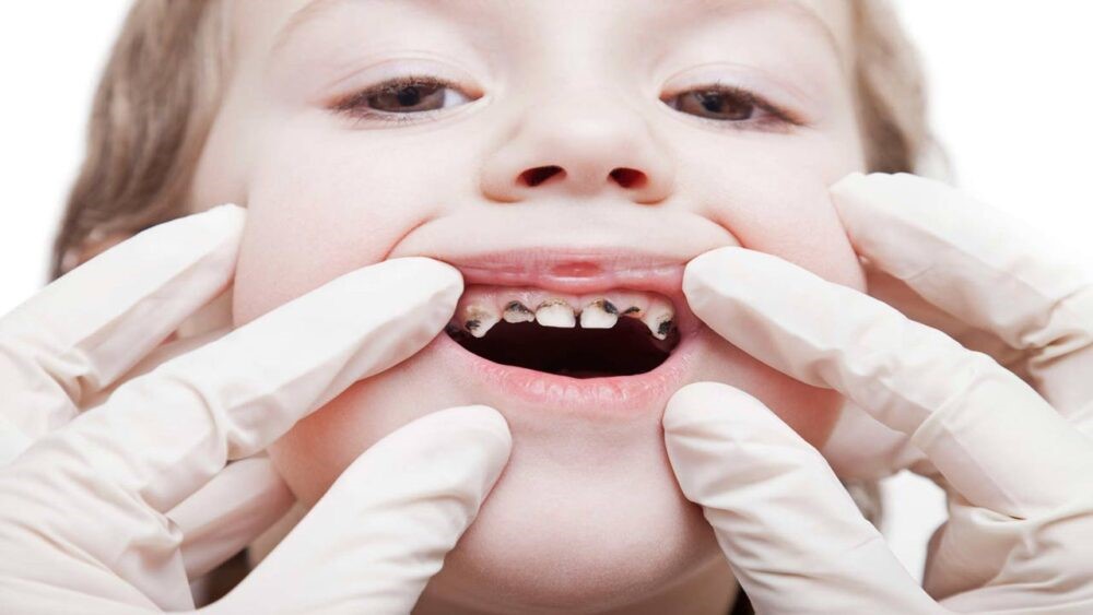 عفونت لثه و دندان در کودکان