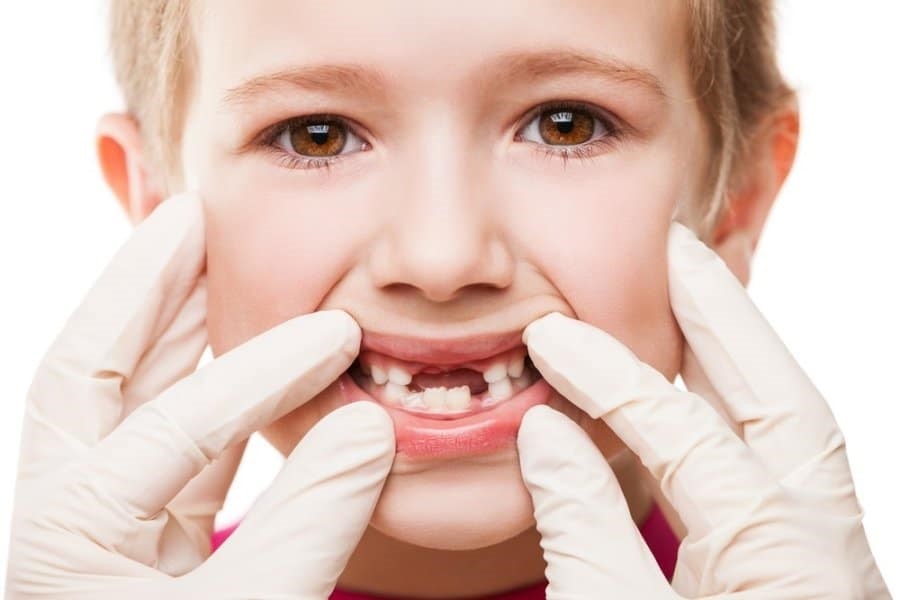 زایلیتول محافظ دندان کودکان در برابر پوسیدگی 