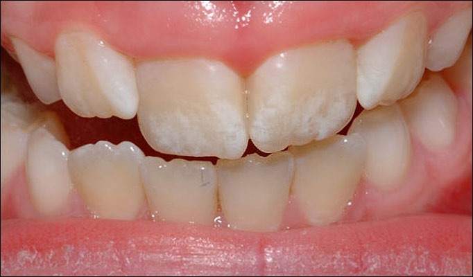 فلوروزیس( لکه سفید روی دندان) در کودکان