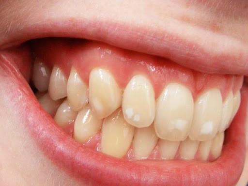 فلوروزیس( لکه سفید روی دندان) در کودکان
