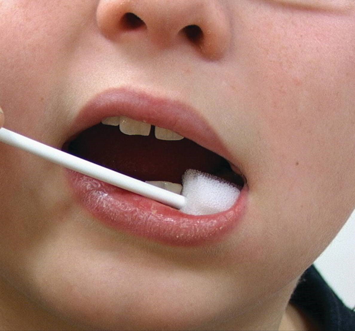 مراقبت دندانی کودکان معلول