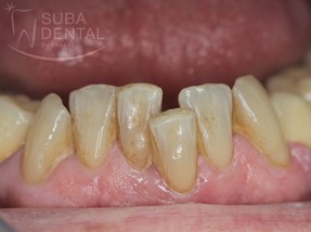اهمیت دندان های پیشین یا ثنایا