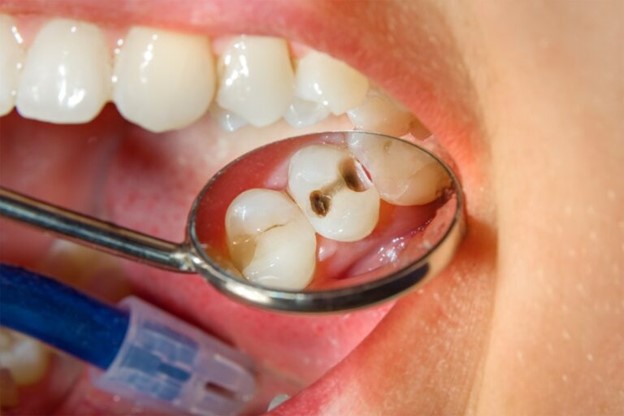 کرم خوردگی های دندان کودکان