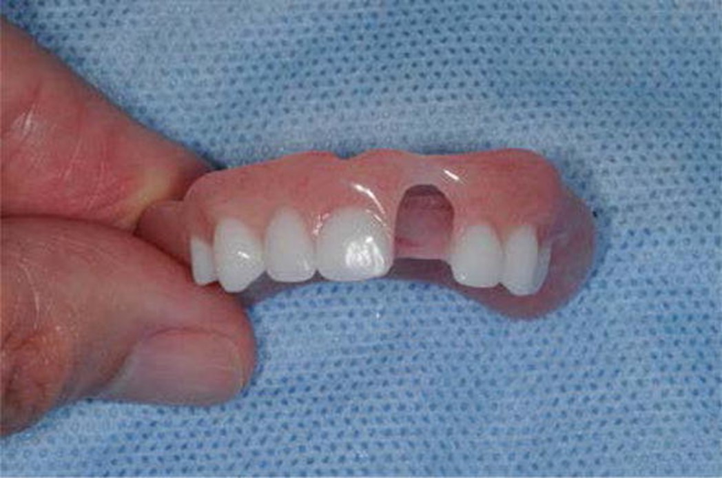 دندان مصنوعی یا پروتز دندان کودکان