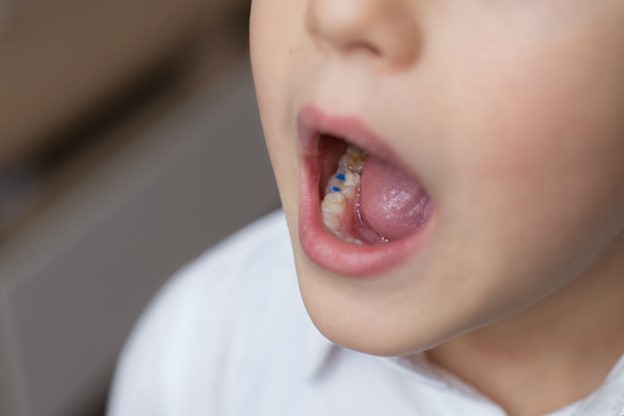 پر کردن دندان برای کودکان