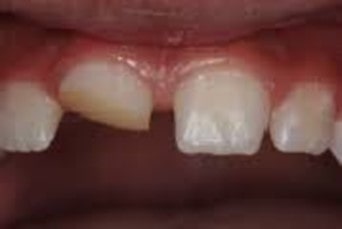 دستورالعمل های درمان دندان های دائمی کنده شده با اپکس باز