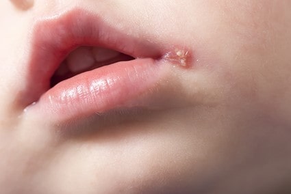 تبخال دهانی در کودکان خردسال