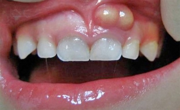 آبسه دندان در کودکان خردسال