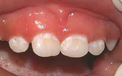 دندان های گچی در کودکان خردسال